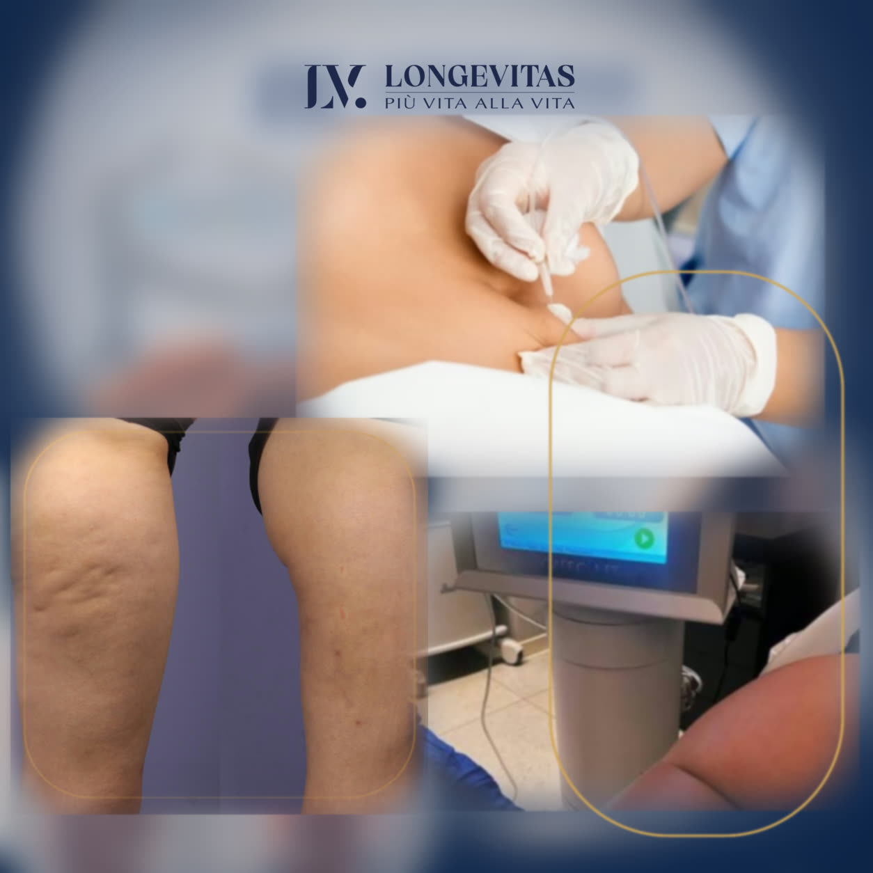 Carbossiterapia Medica